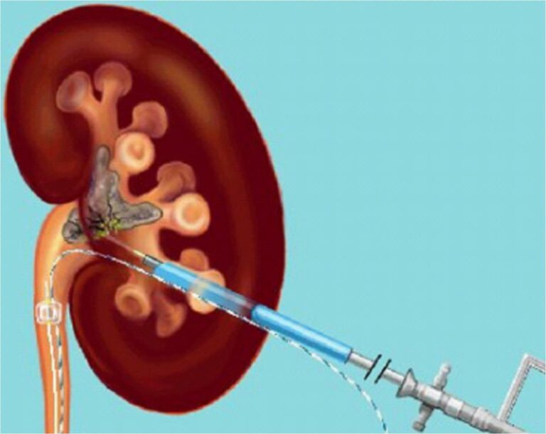 Percutaneous nephrolithotomy