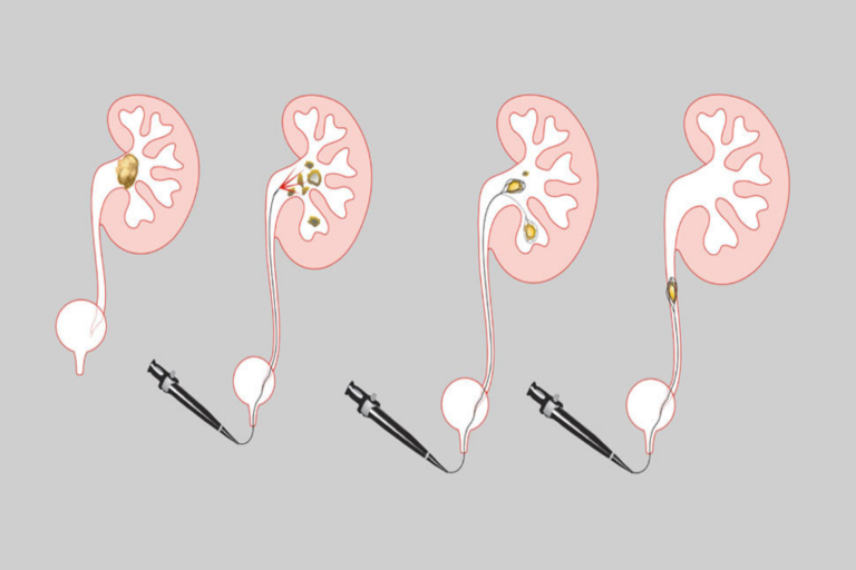 Cara Mengeluarkan Batu Ginjal di Saluran Kemih